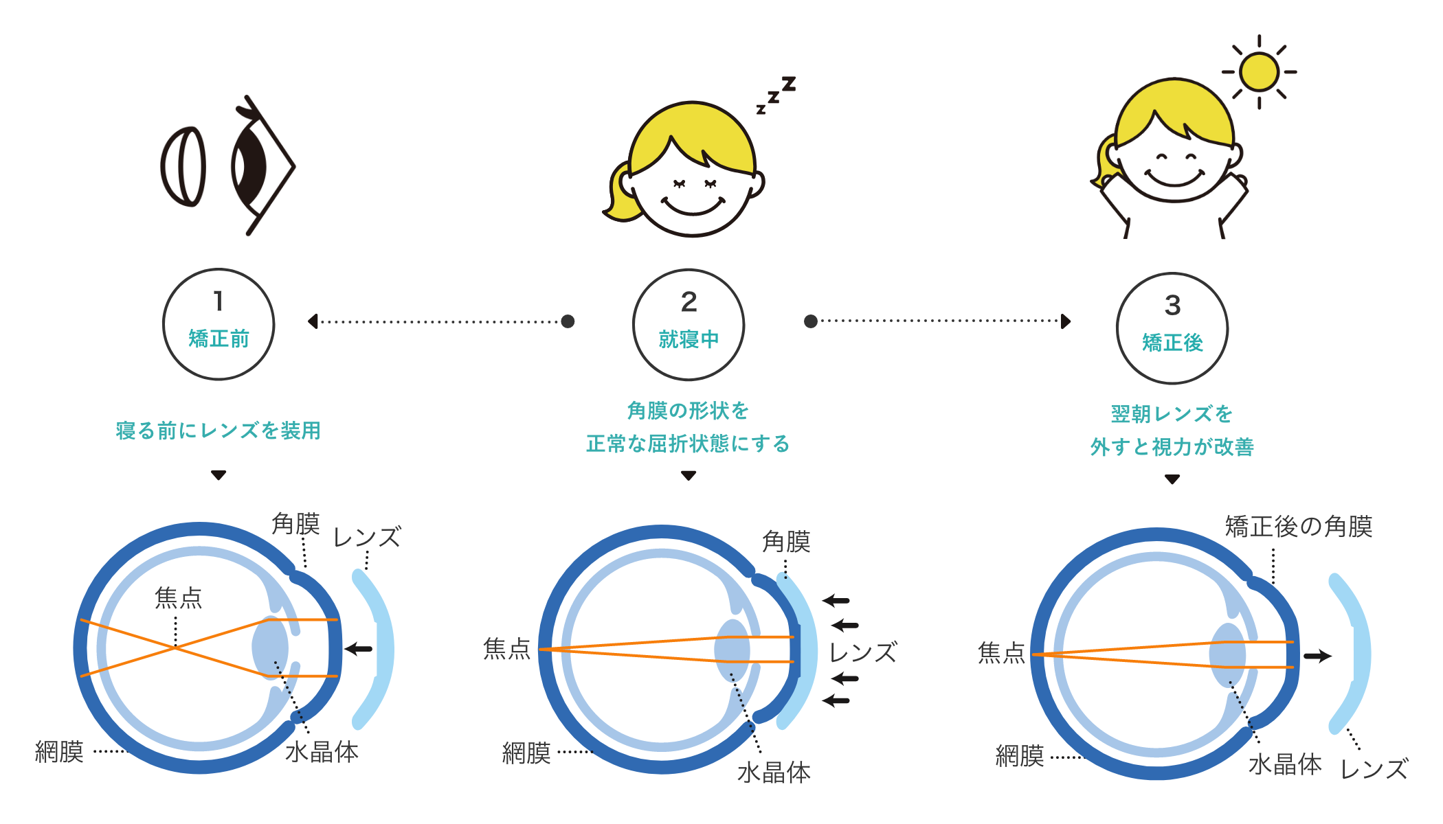 オルソケラトロジーの仕組み