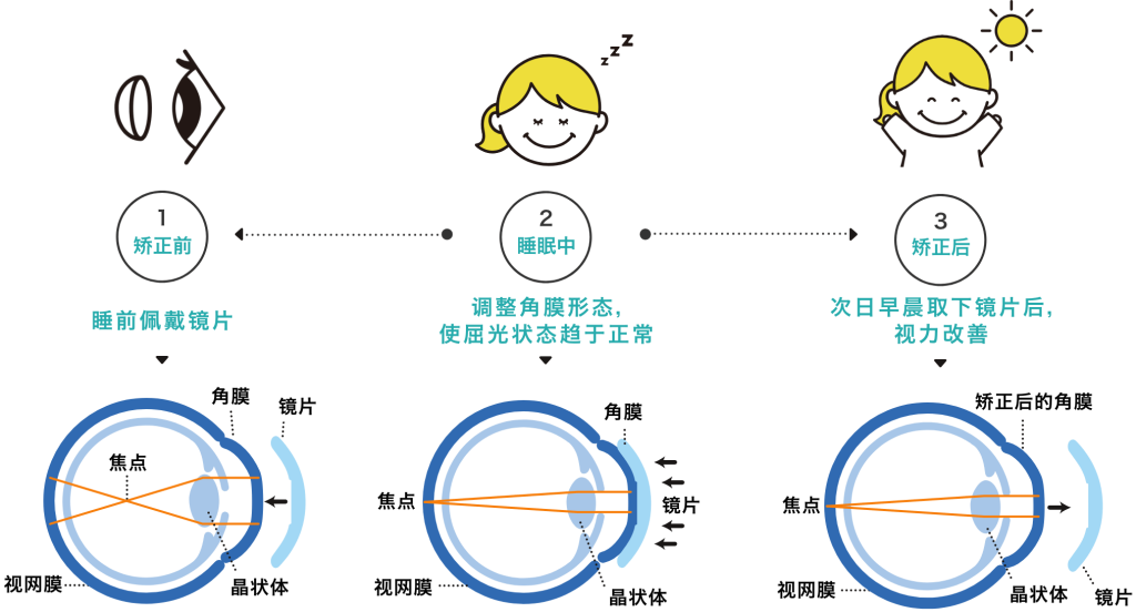 OK镜治疗流程图